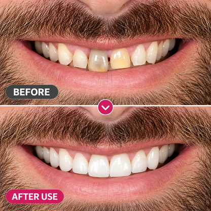 TopSpire™ DenPerm Cavity-Repair Natural Enamel Filling Gel